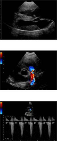 cardiopatie screening stenosi polmonare