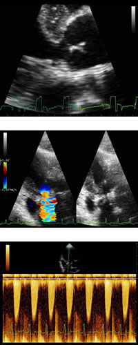 cardiopatie screening stenosi subaortica